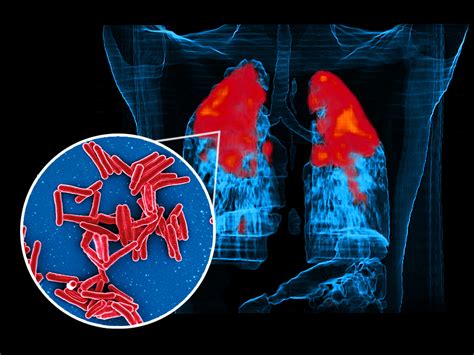 Tuberculosis isn't often seen in Australia, but I tested positive for .